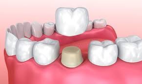 Dental Implant