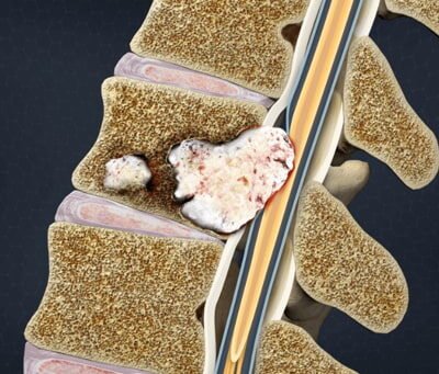 How Early Specialist Intervention for Metastatic Spinal Tumours Preserves Function and Extends Quality Life