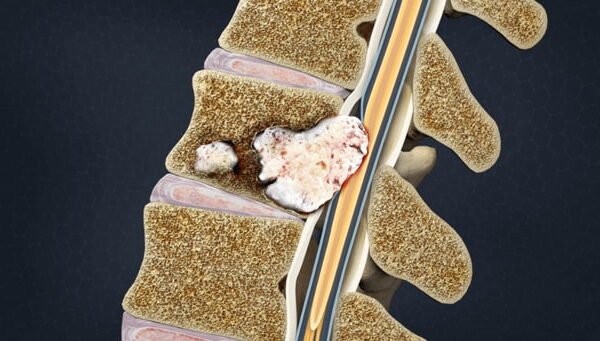 How Early Specialist Intervention for Metastatic Spinal Tumours Preserves Function and Extends Quality Life