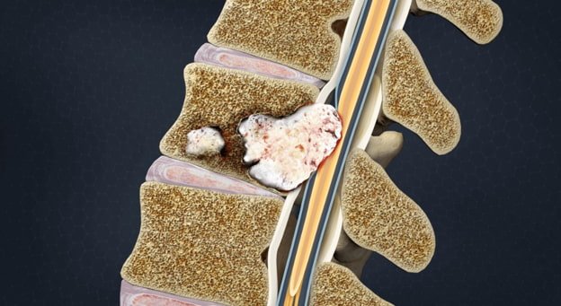 Metastatic Spinal